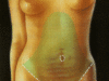 abdominoplastia