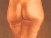 liposuccin