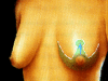 mastopexia