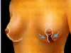 mastopexia