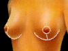 mastopexia